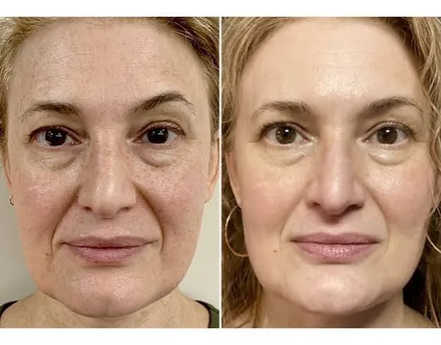 Forma Facial Results